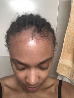 a girl having excessive hair shedding