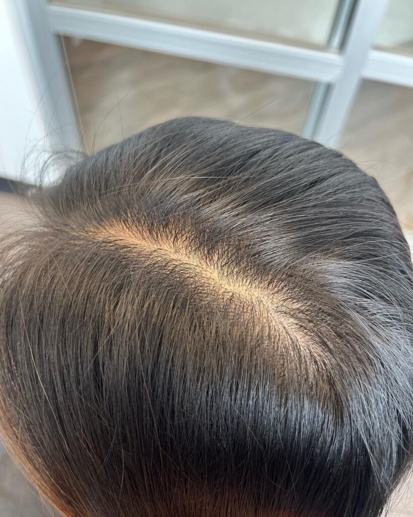 picture of a dry scalp