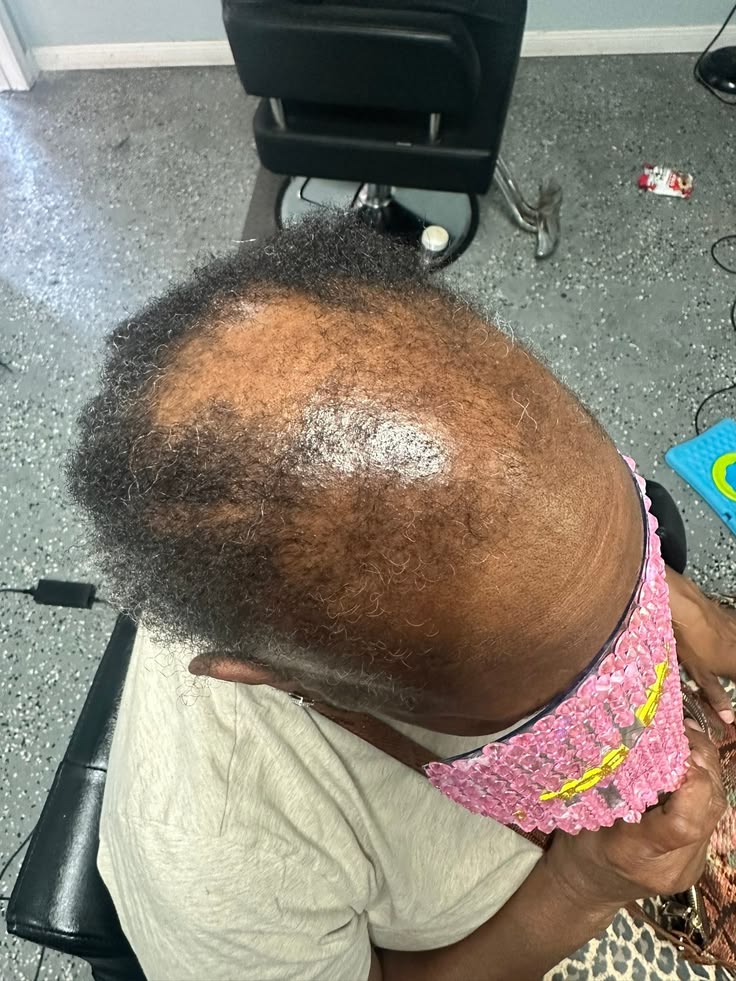 someone with excessive hair loss