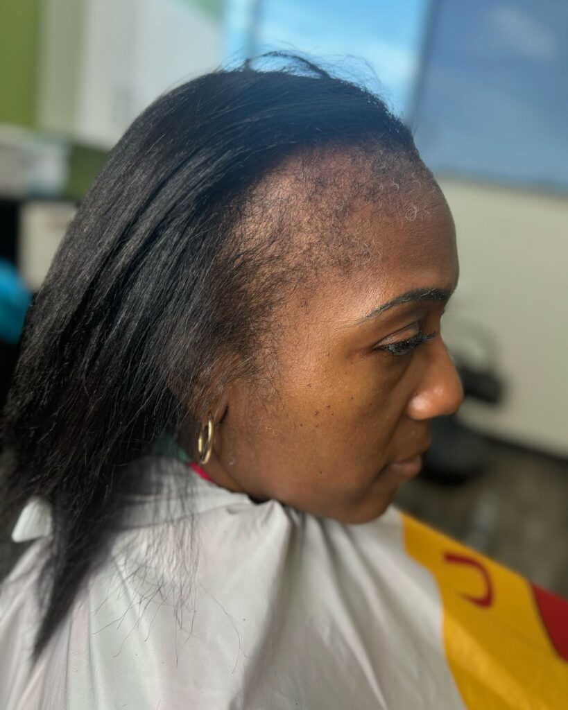 someone with hair loss