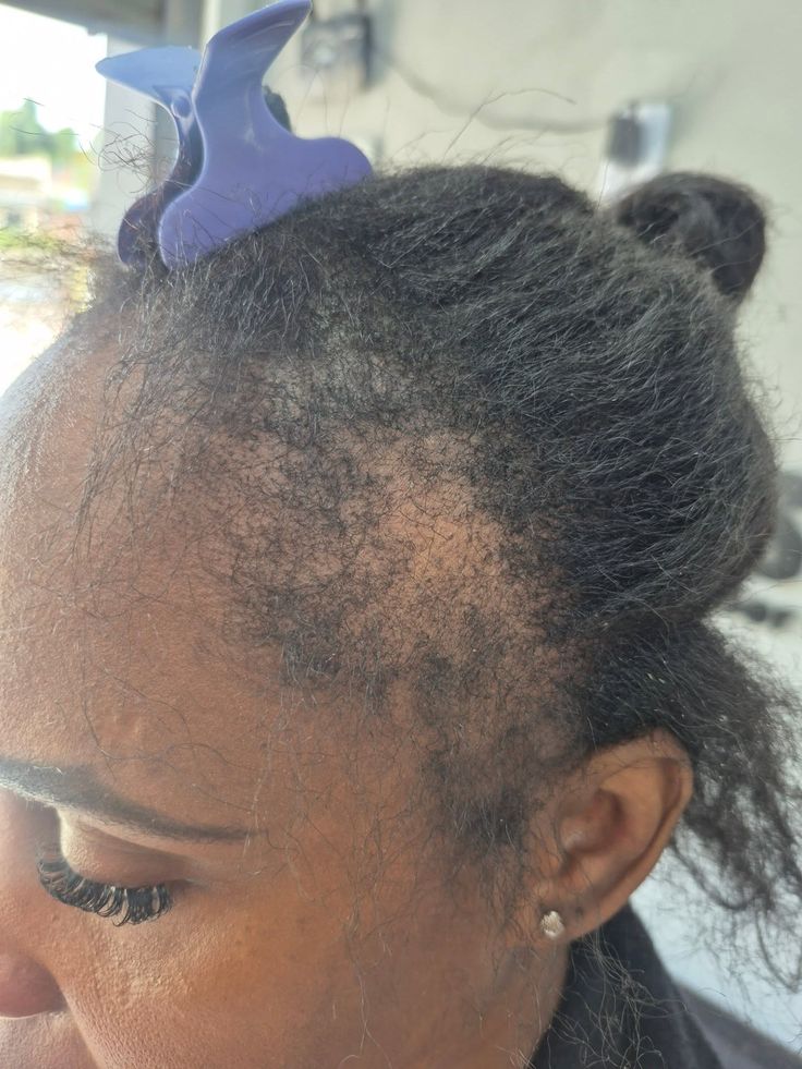 someone with front hair loss