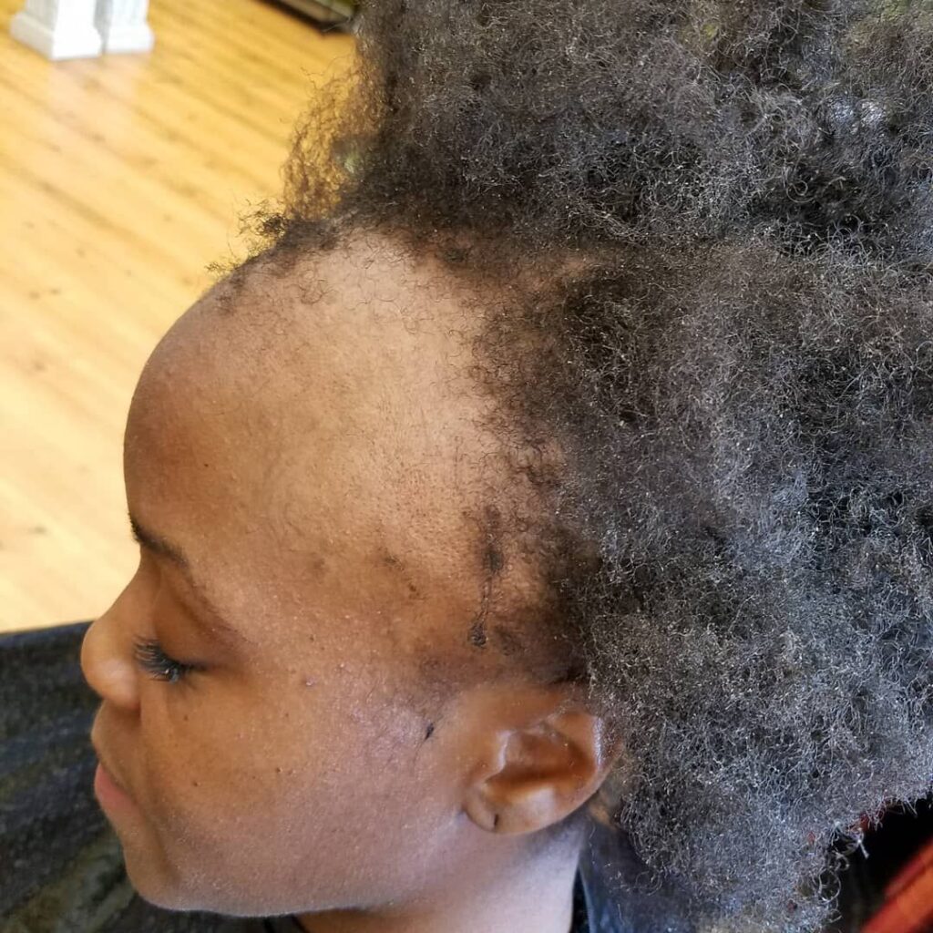 someone having front hair shedding
