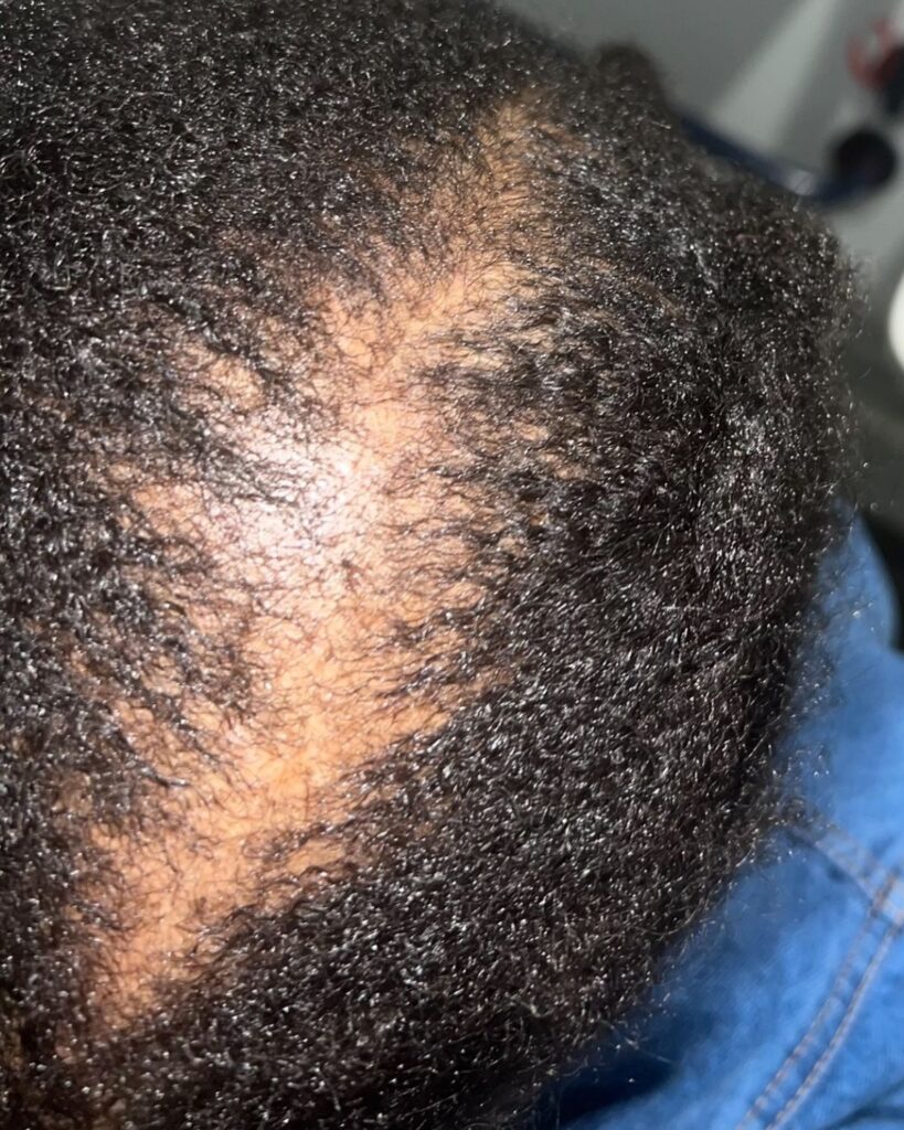 someone having a hair loss