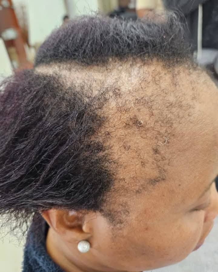 a lady suffering hair loss
