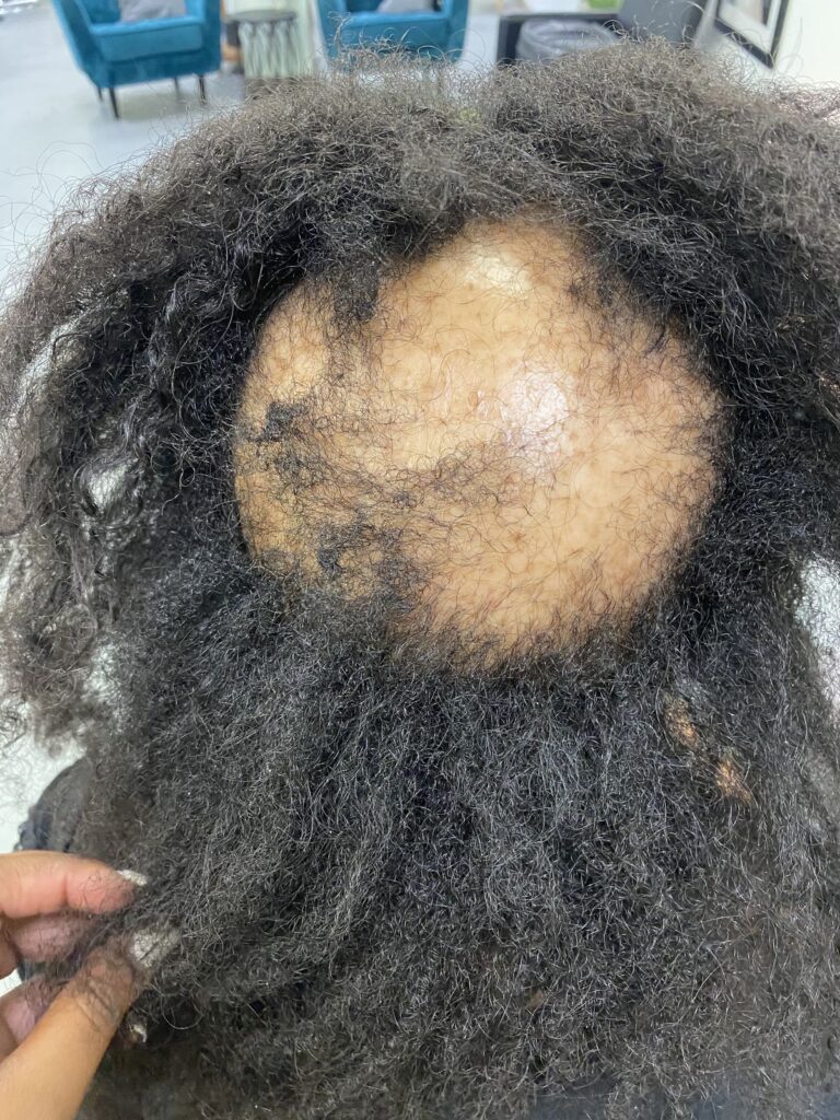 someone having middle hair loss