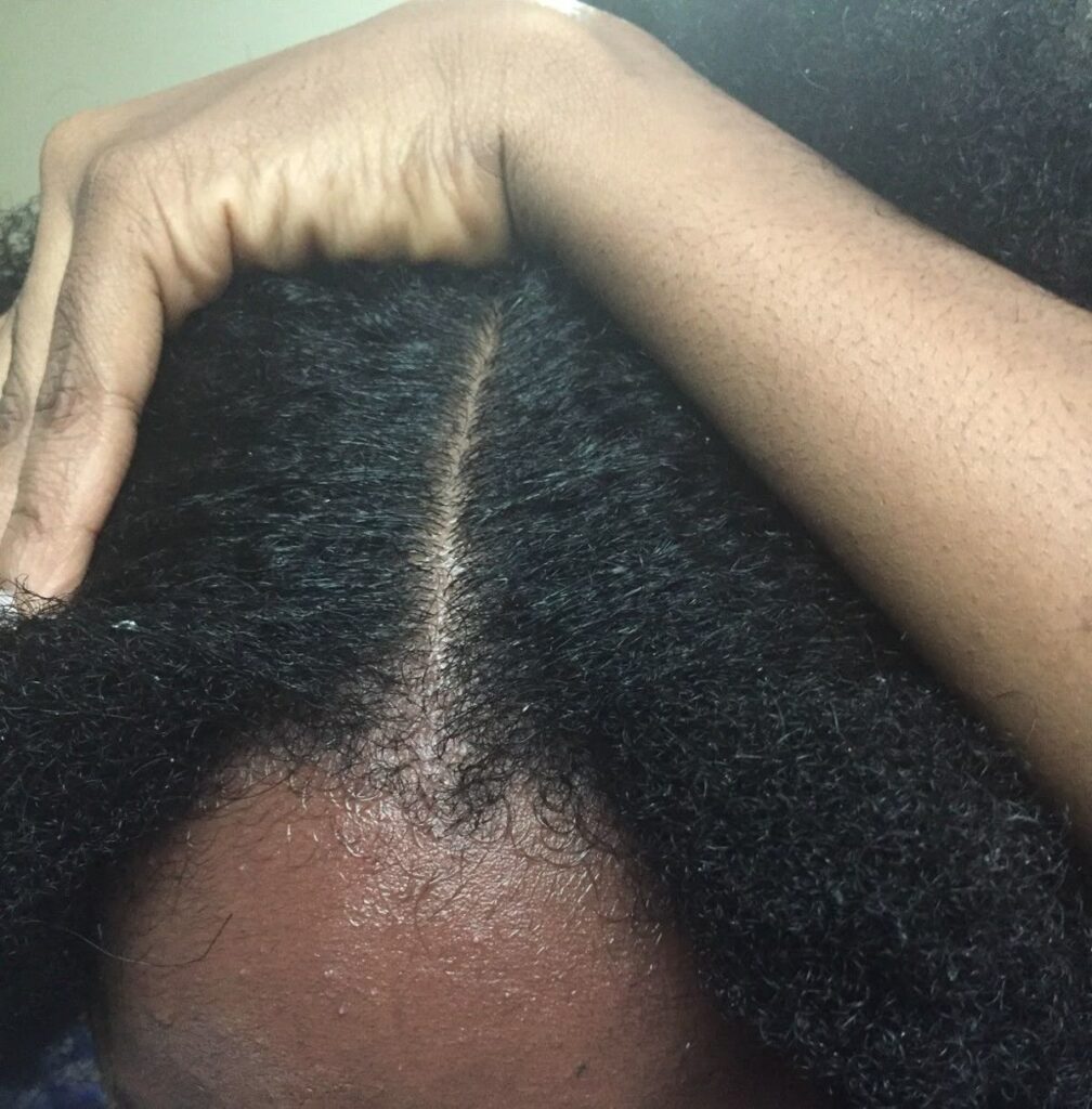 someone with a healthy scalp