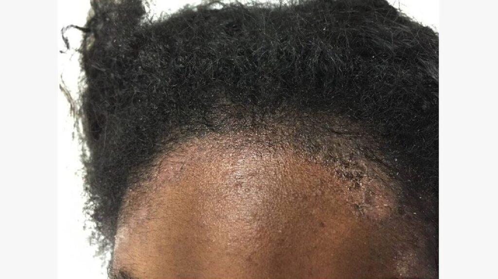 picture of scalp irritation