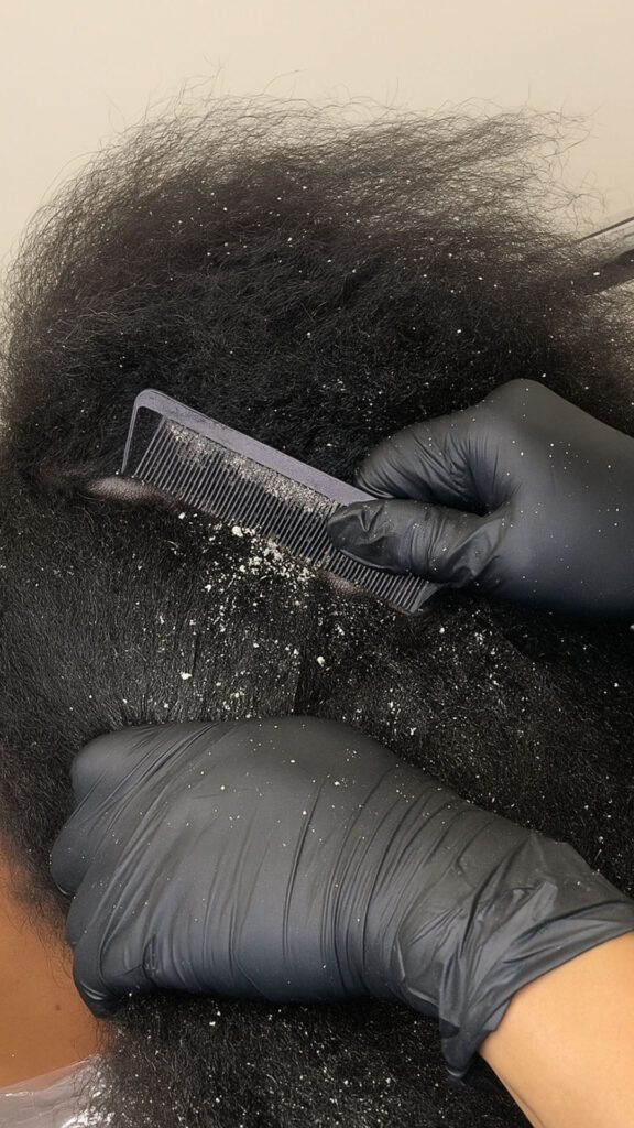 picture of a scalp suffering dandruff
