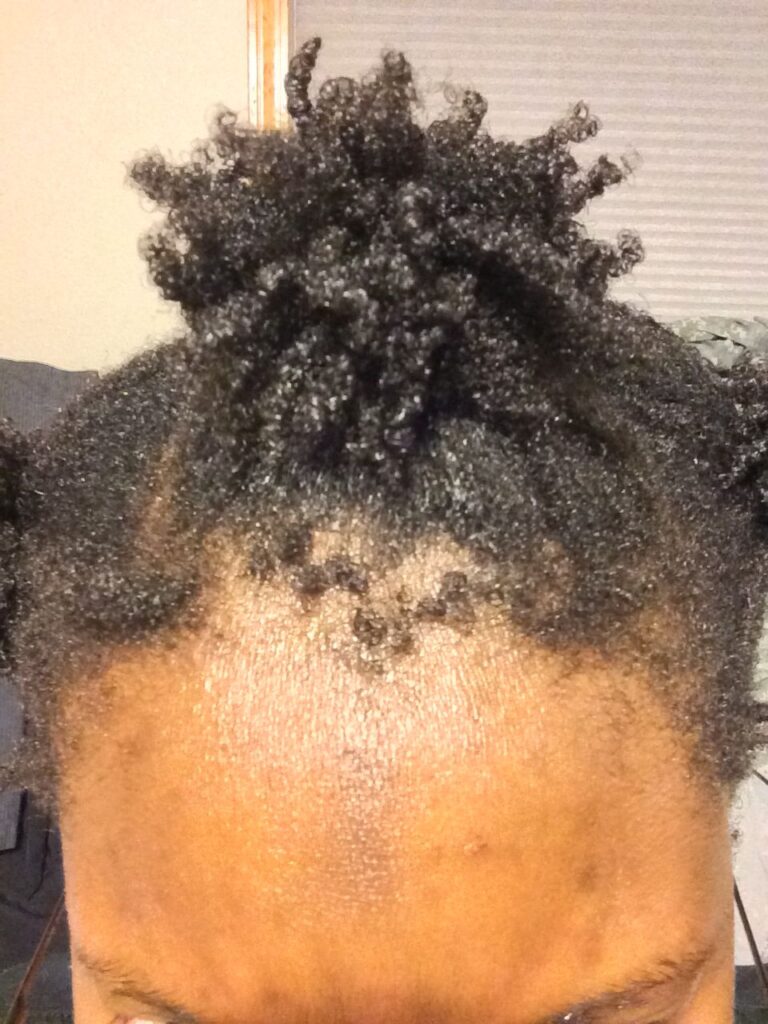 someone with short hair having hair shedding issue