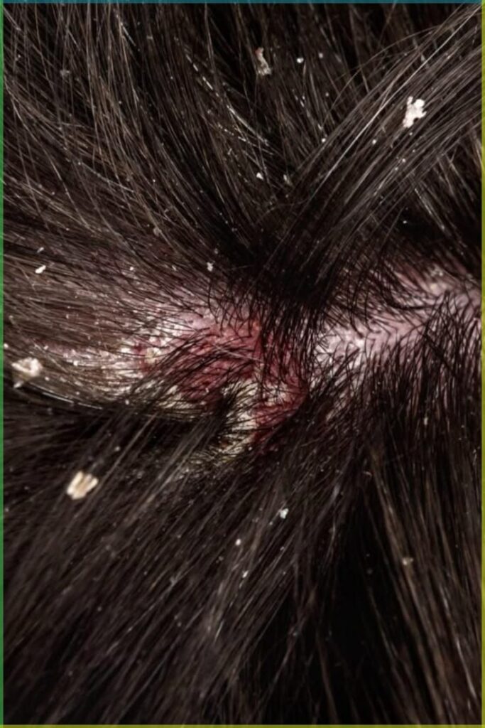 picture of unhealthy scalp