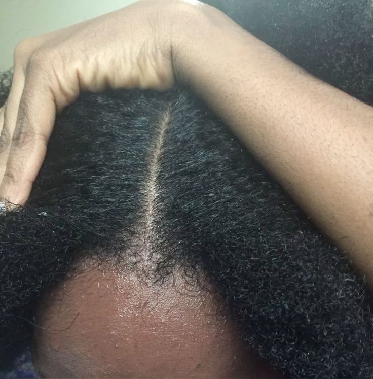 someone with dehydrated scalp