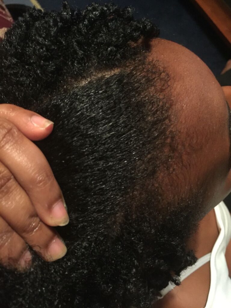 someone showing her dehydrated scalp