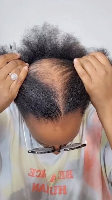someone with scalp bald patches
