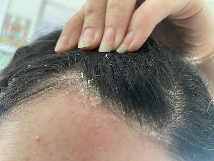 someone with scalp dandruff
