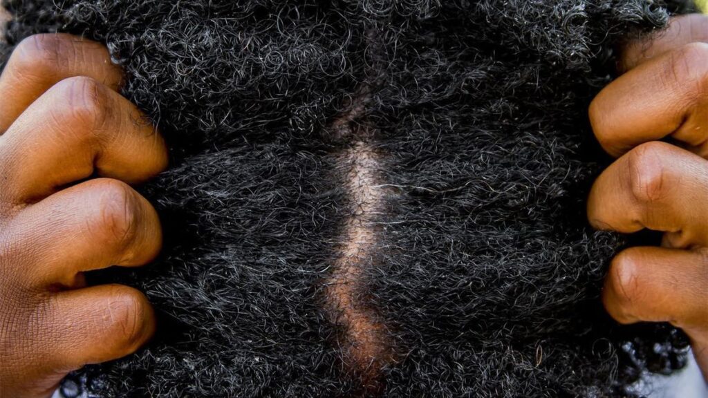 someone with a dry scalp