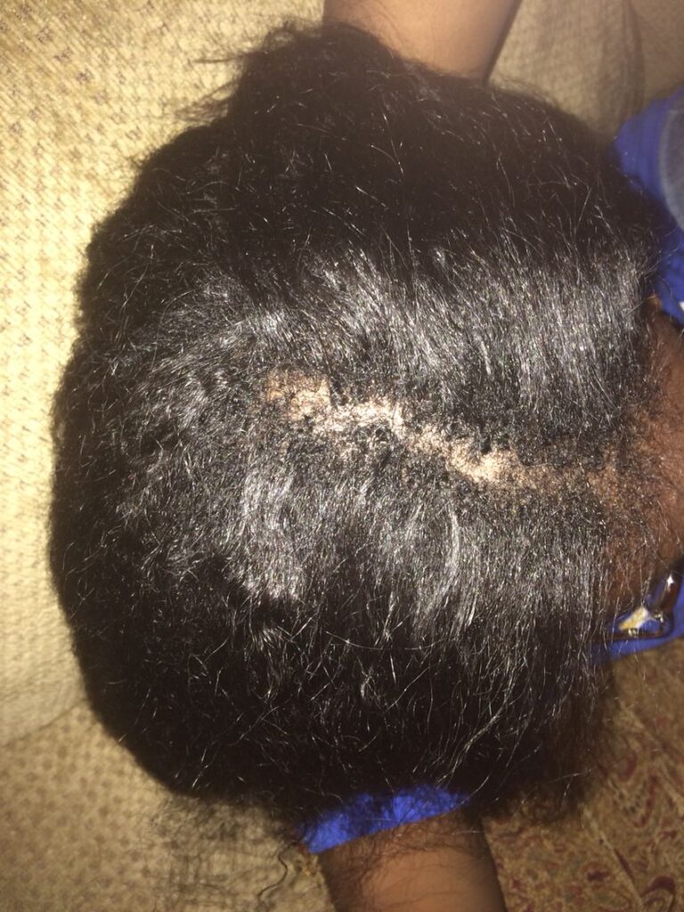 someone with a dry scalp