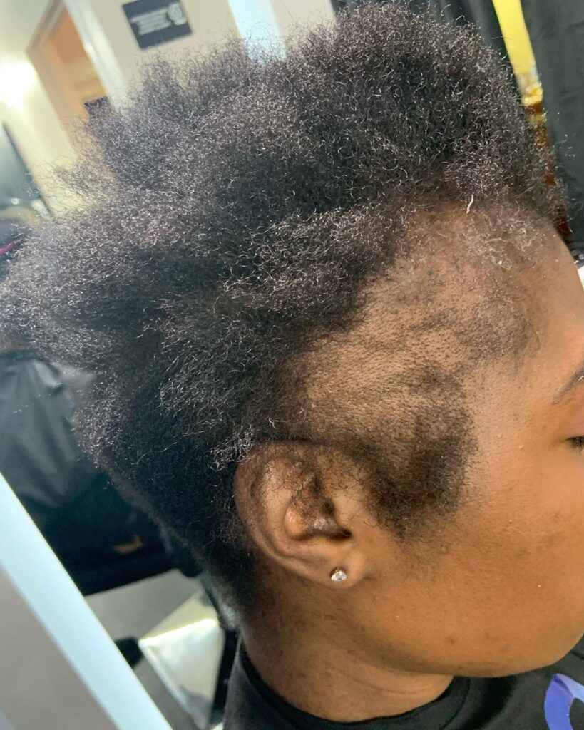 someone with front hair shedding not breakage