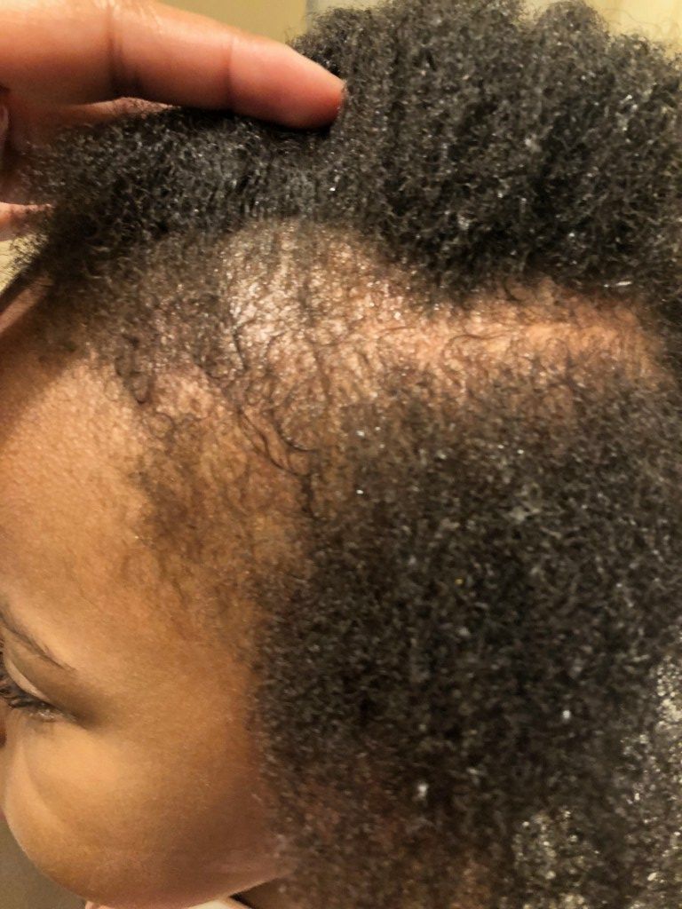 someone with hair loss issue
