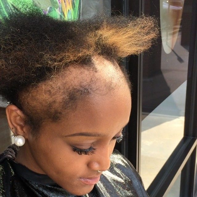 someone suffering hair shedding not breakage