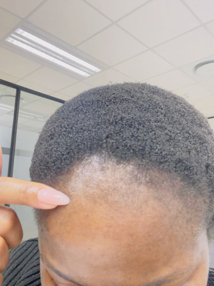 someone having hair shedding