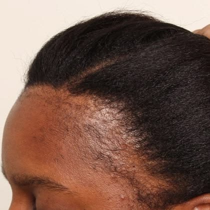 someone having hair shedding not breakage