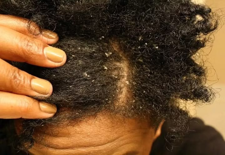 picture of a scalp that needs a detox