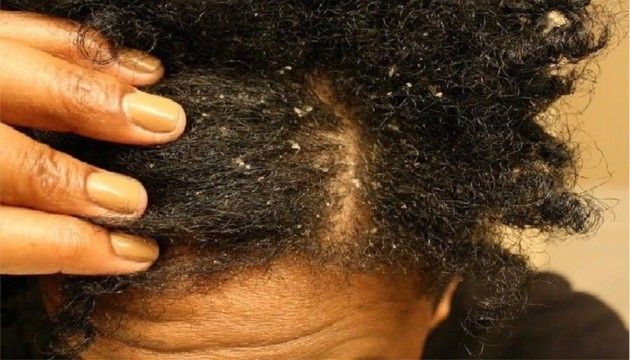 someone with an itchy scalp