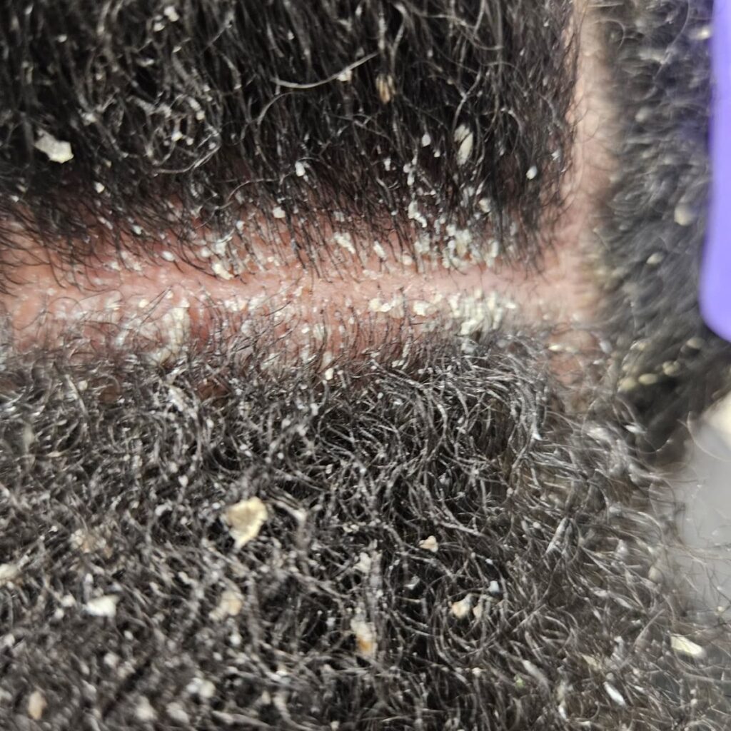 picture of scalp buildup