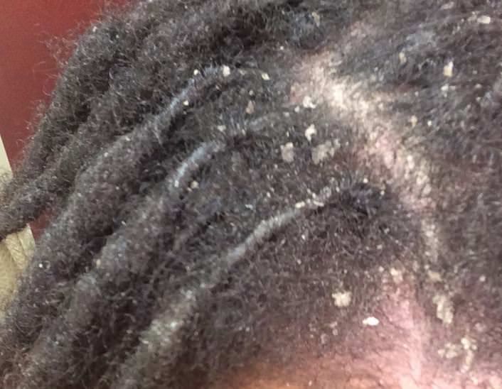 a scalp flakes that need a detox