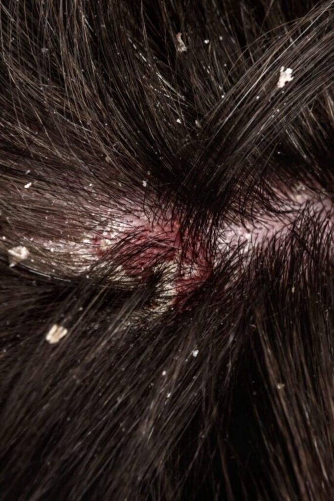 someone with scalp flakes