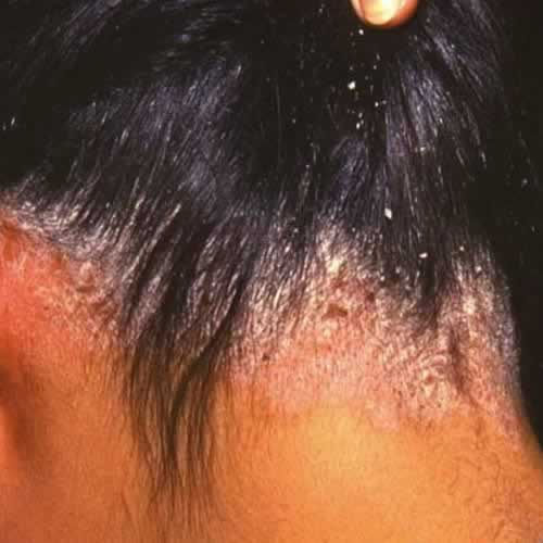 someone having scalp problem