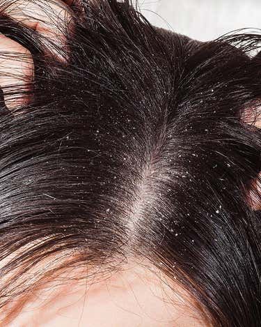 picture of unhealthy scalp that needs a detox