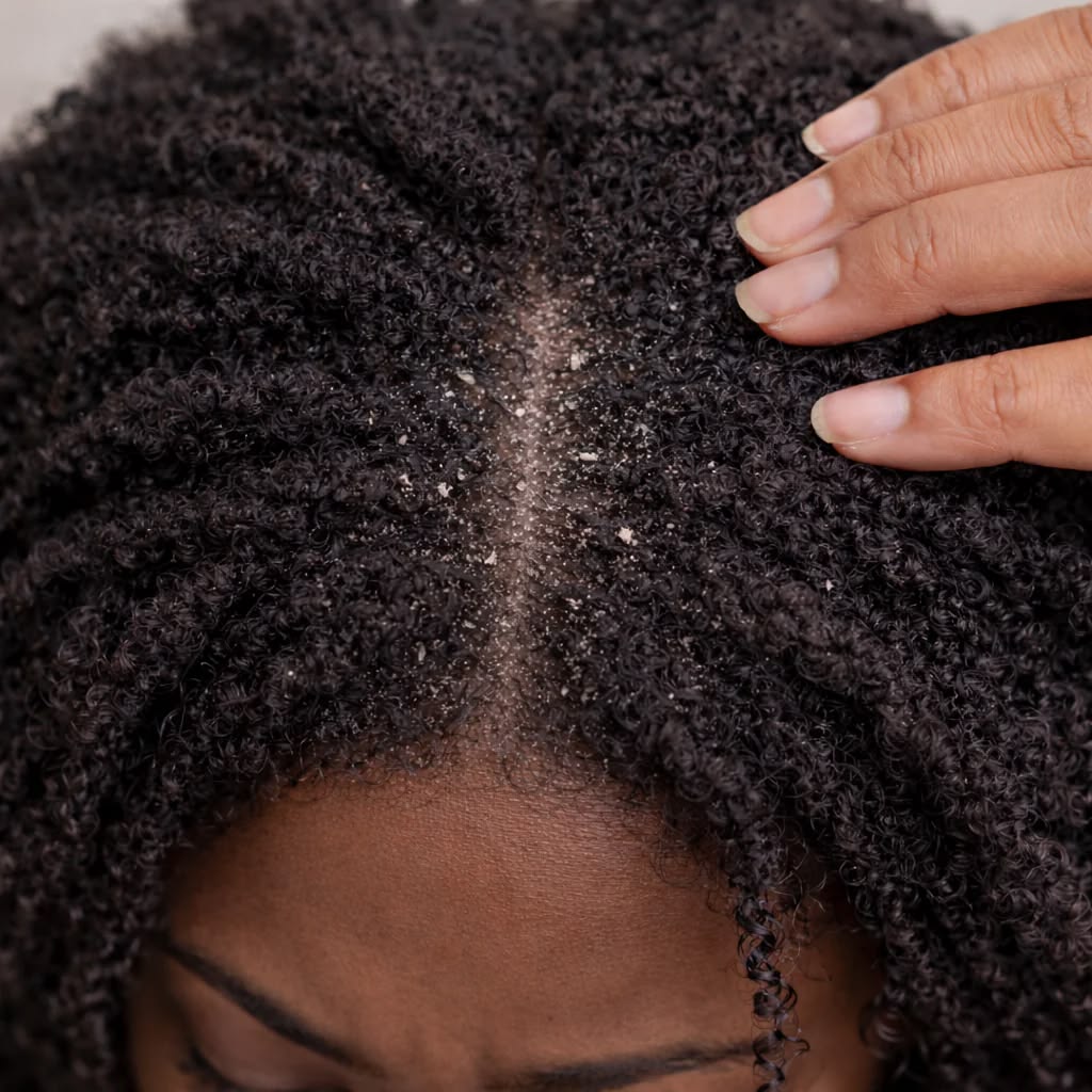 a dry scalp with flakes