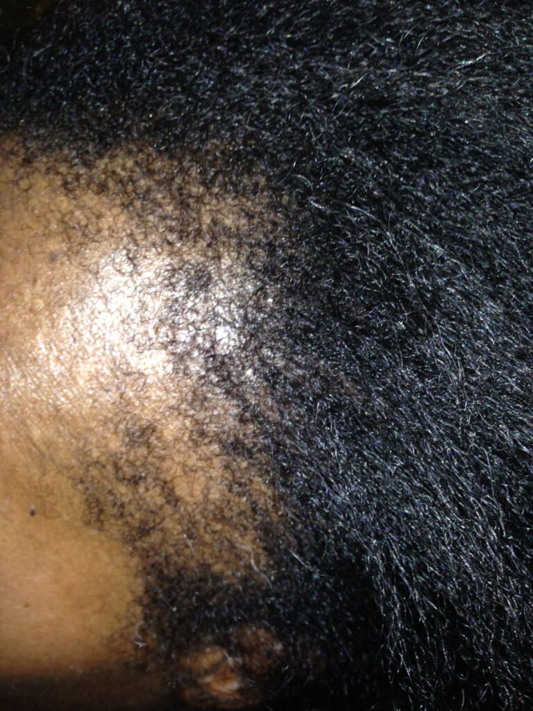 someone with front hair loss