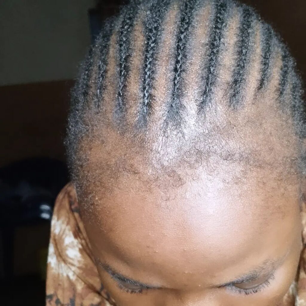 someone with thin edges caused by hairstyle that could be damaging your hairline