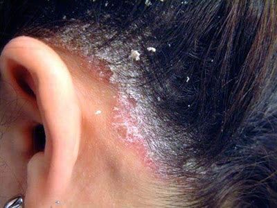 someone with unhealthy scalp