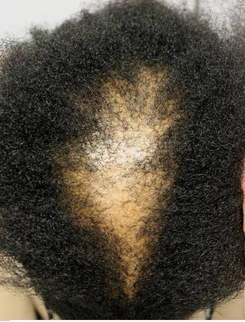 someone with a bald head