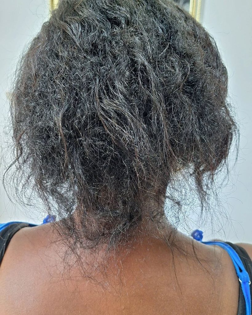 someone with hair loss